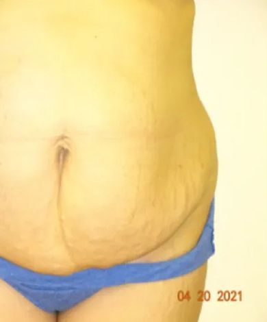 Abdomen with loose skin and stretch marks, wearing blue underwear. Date stamp: April 20, 2021.