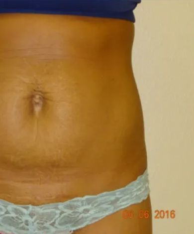 Tan torso wearing blue top and light blue lace underwear, showing stretch marks.