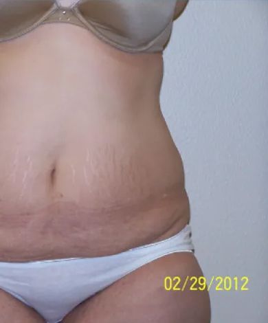 Torso of a person in underwear, showing stretch marks on the abdomen. Date: February 29, 2012.
