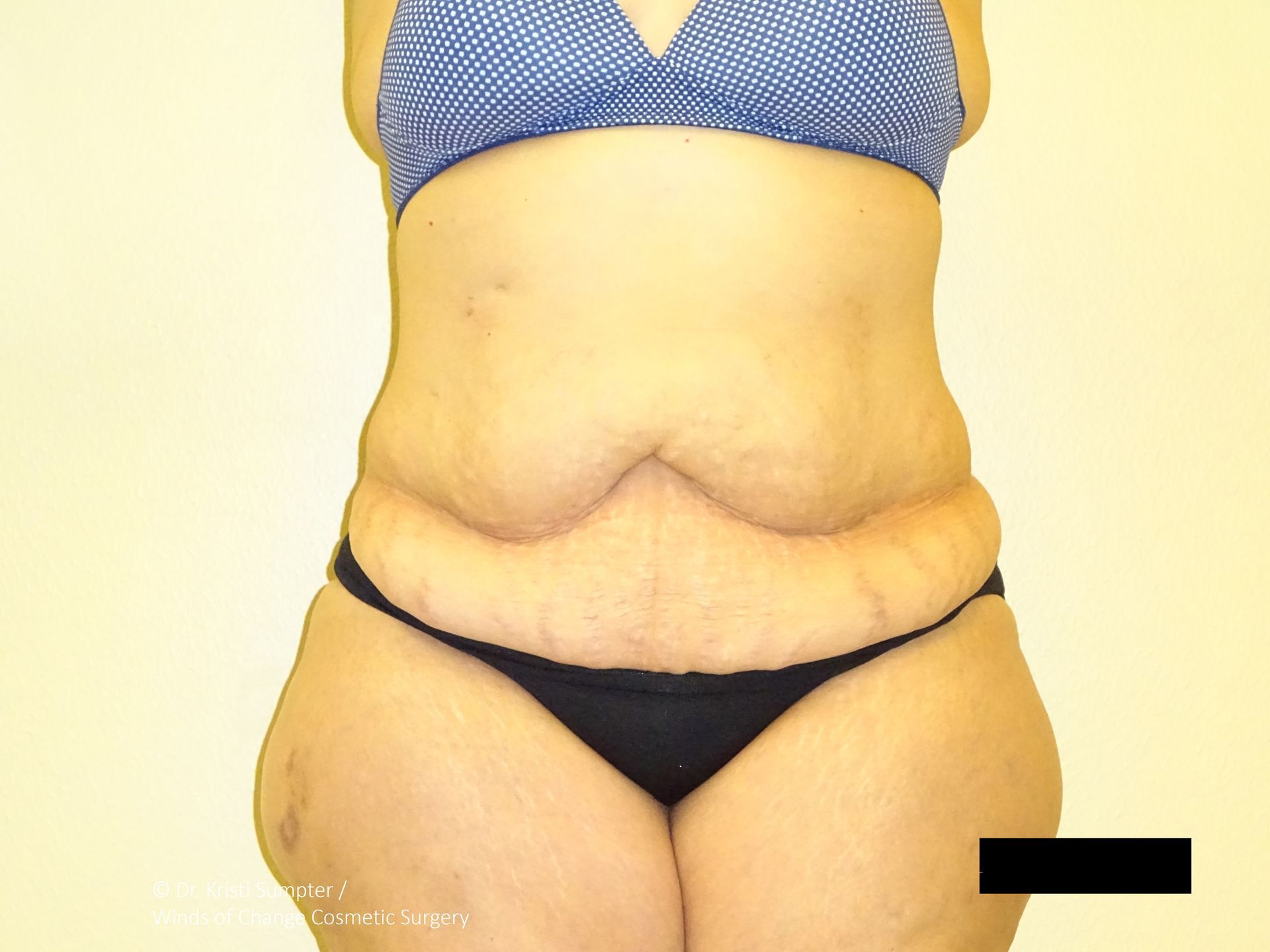 Torso of a person in a blue bra and black underwear, showing excess skin folds on the abdomen.