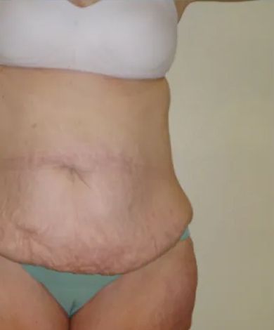 Torso with visible stretch marks, a white bra, and turquoise underwear.