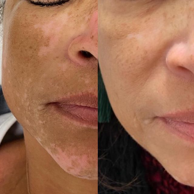 Before and after image