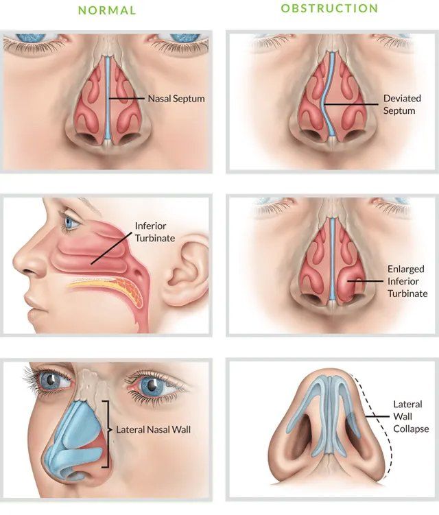 nasal anatomy turbinates