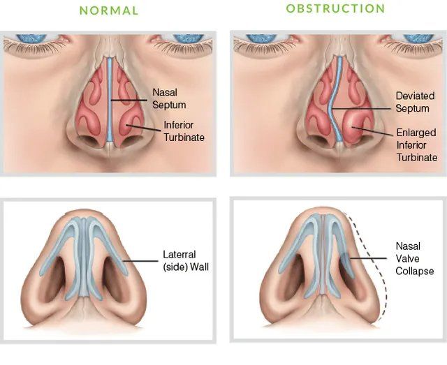 Anatomy of Nasal Airway Obstruction