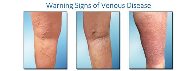 Warning signs of venous disease