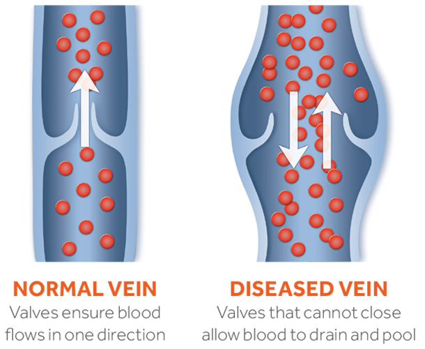 Normal and Diseased Veins