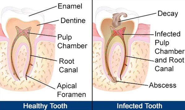 Healthy tooth - infected tooth