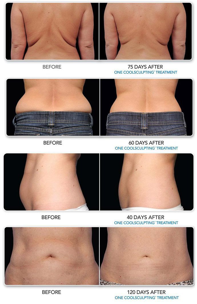More Coolsculpting results