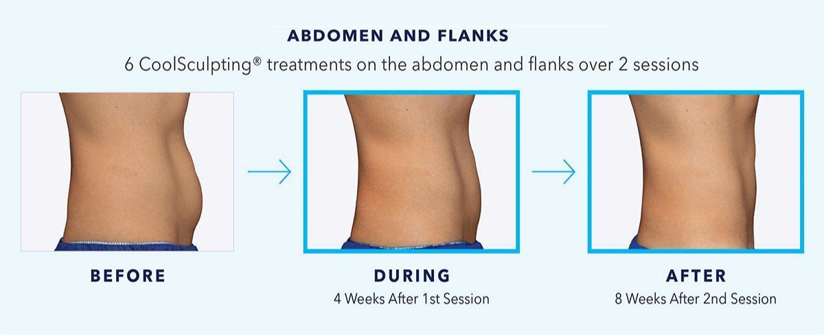 Coolsculpting results