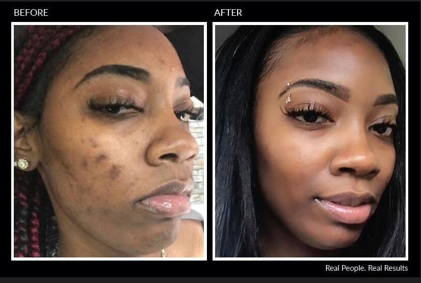 Before and after photos: woman with acne, then clear skin, dark complexion.