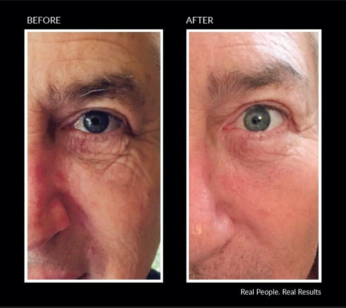 Side-by-side comparison of a man's eye, showing wrinkles