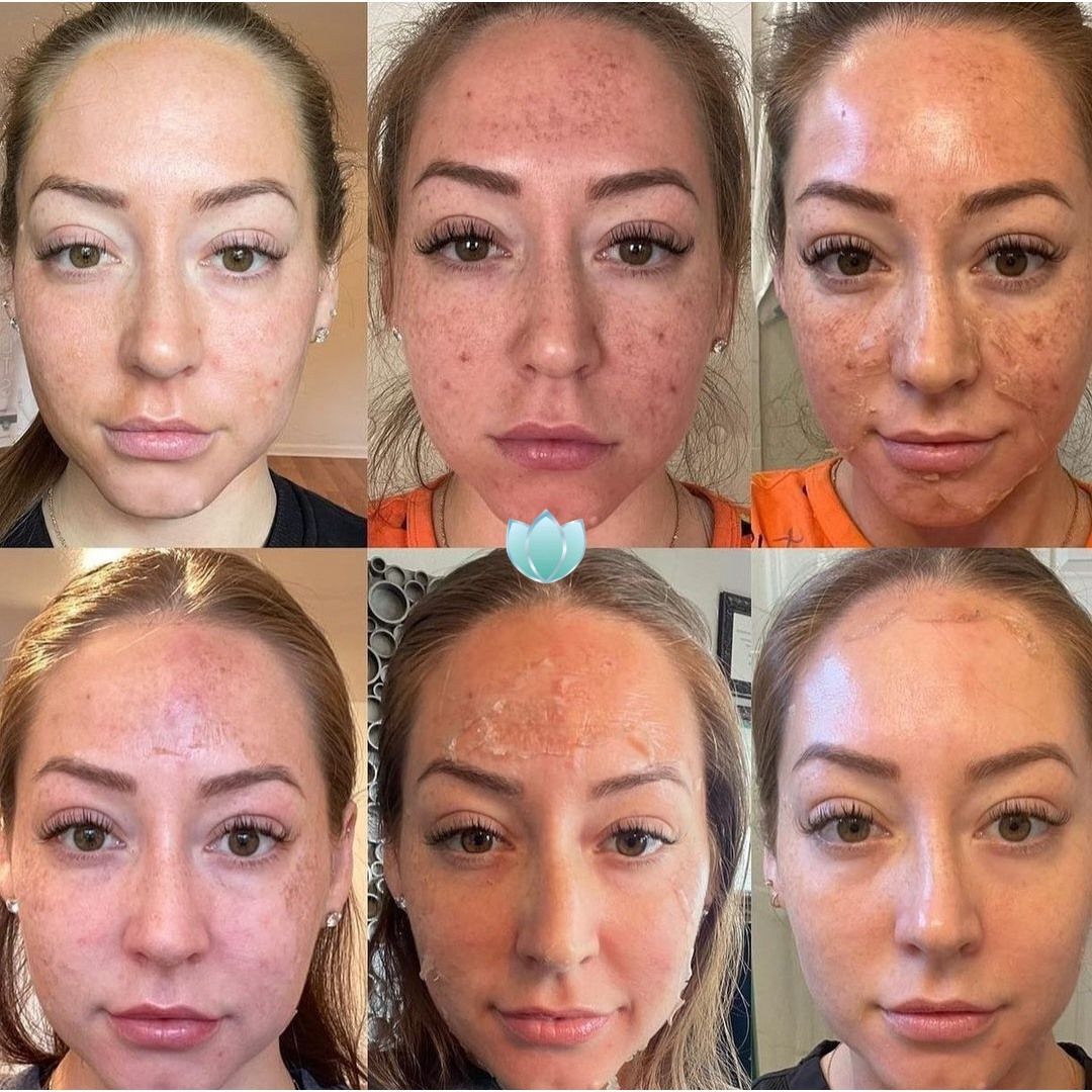 Progress photos of a woman's face. Shows skin treatment effects; redness and healing over time, with improved complexion.