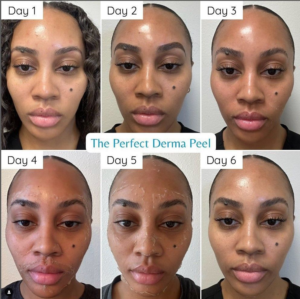 Progression of a woman's face after a Perfect Derma Peel over six days, showing skin changes.