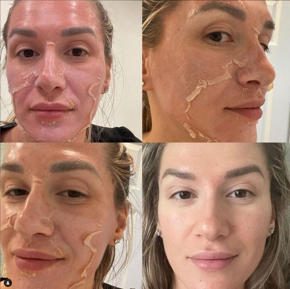 Woman's face before and after skin peel, showing peeling skin and then smooth, improved complexion.