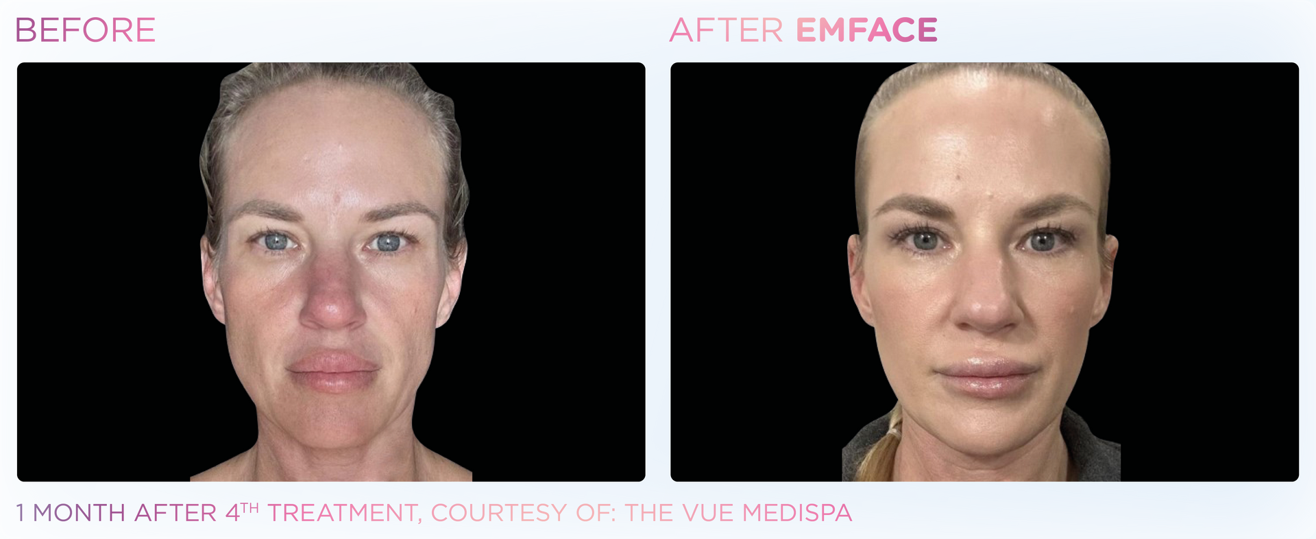 Side-by-side comparison of a woman's face before and after Emface treatment, showing reduced wrinkles and a lifted appearance.