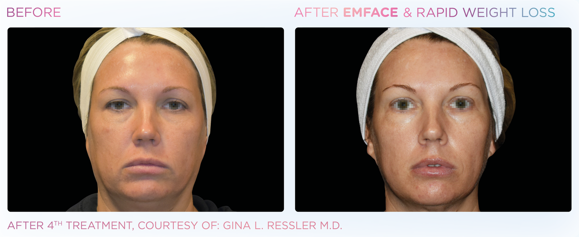 Before and after photos of a woman's face. 