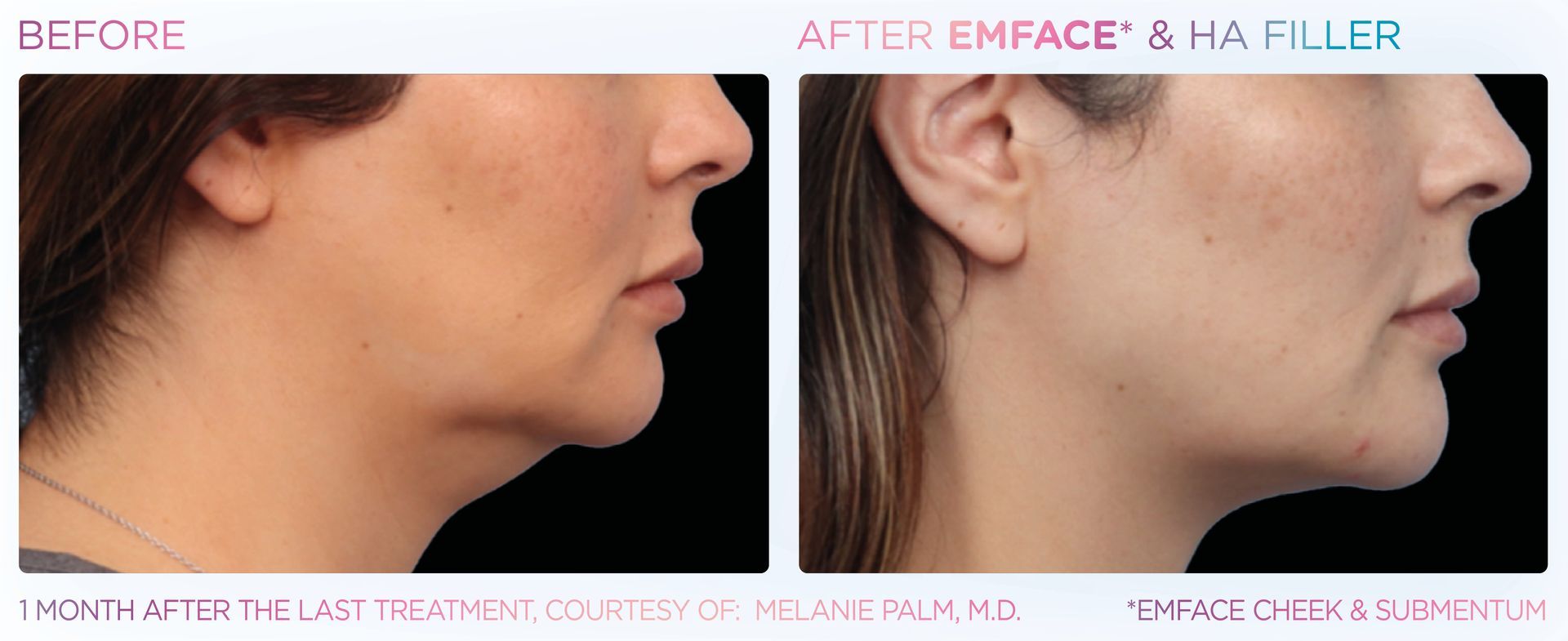 Side-by-side photo of a woman's neck/face before and after Emface & HA filler treatments.