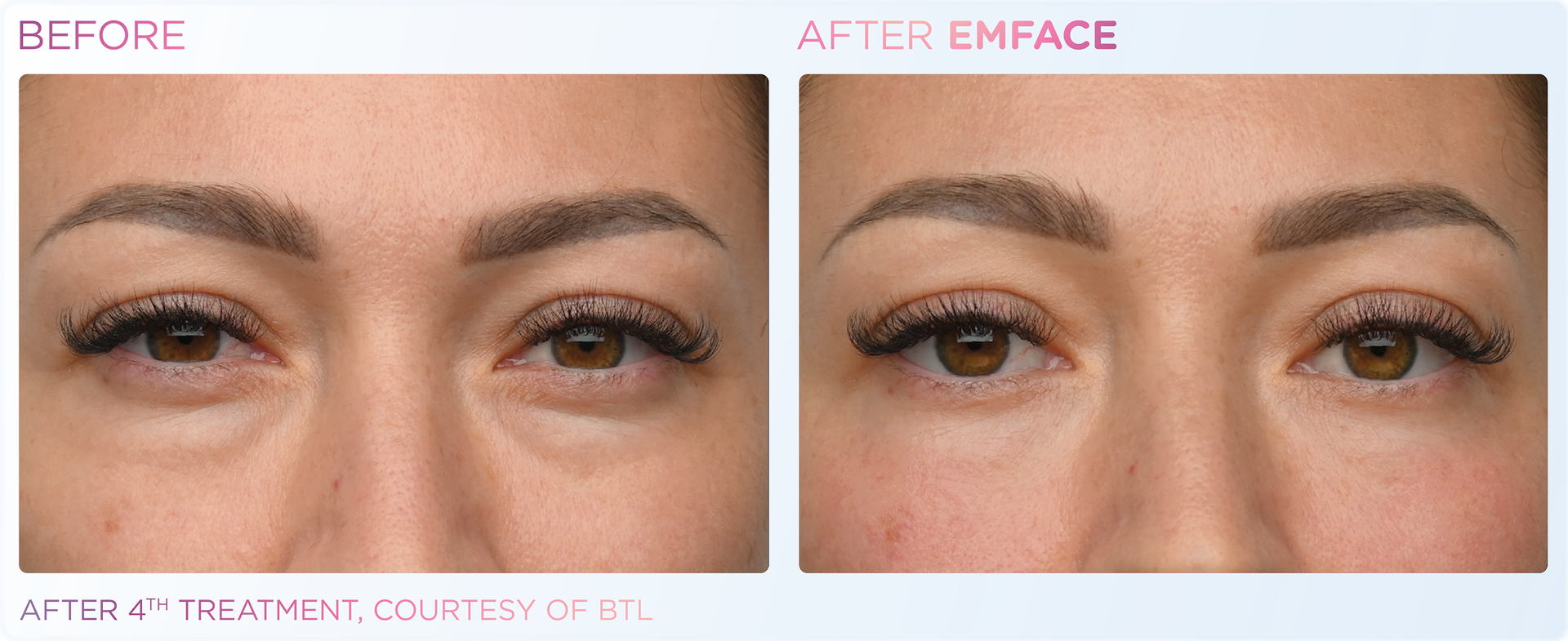Before and after EMface treatment, showing reduced under-eye bags.