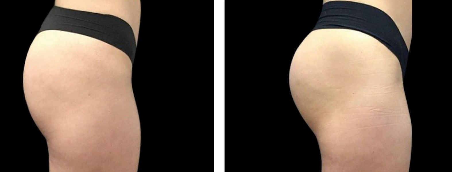 EMSculpt NEO before and after photo