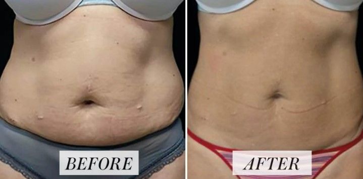 A before and after picture of a woman's stomach