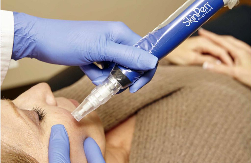 SkinPen microneedling treatment on a woman's face, performed by a gloved hand.