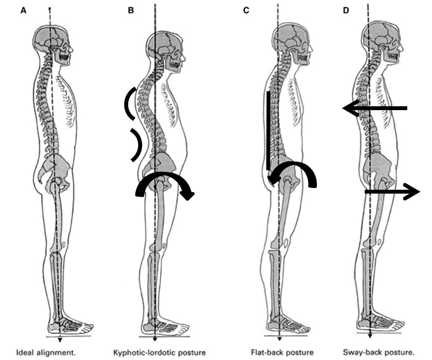 Four side-view spine posture diagrams: ideal, kyphotic-lordotic, flat-back, and sway-back.