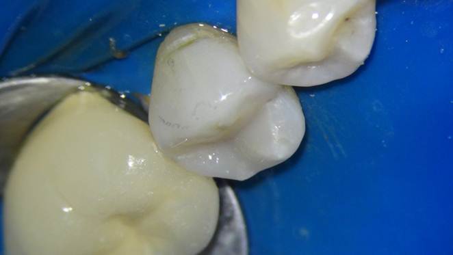 Composite white filling