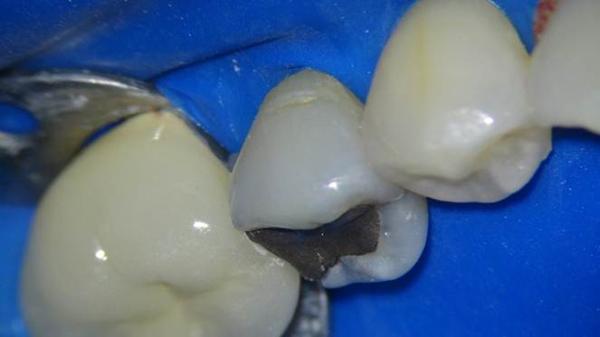 Composite white filling