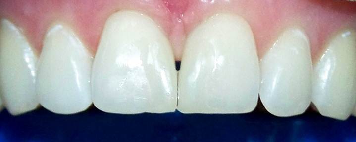 Diastema Closure Composite