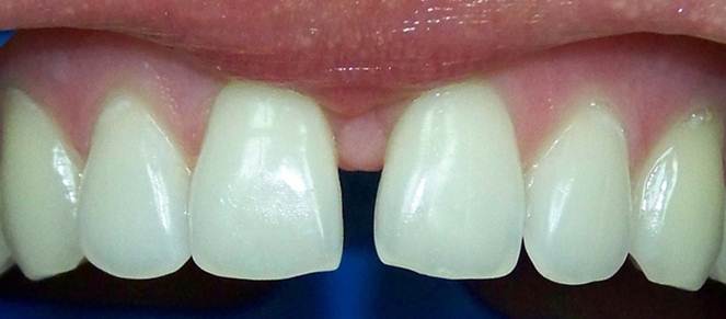 Diastema Closure Composite