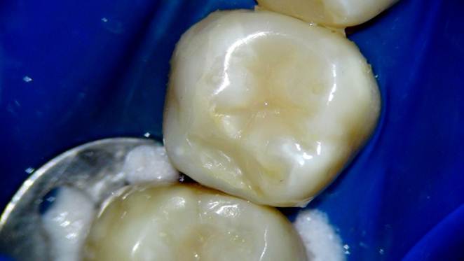Replacing Silver Fillings