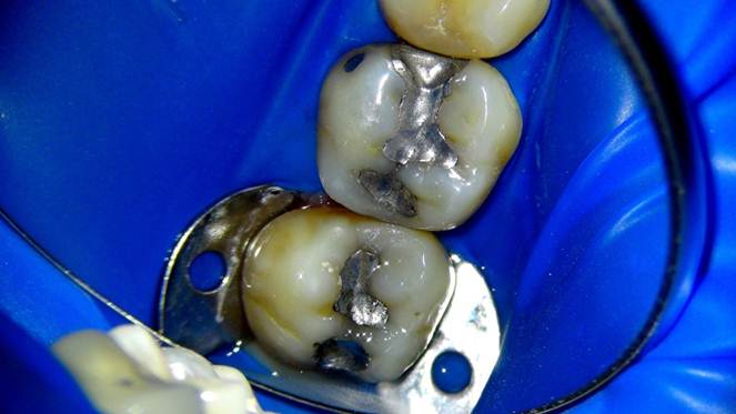 Replacing Silver Fillings