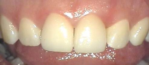 Replacing Old Crowns