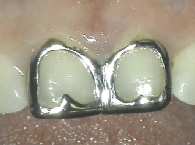 Replacing Old Crowns