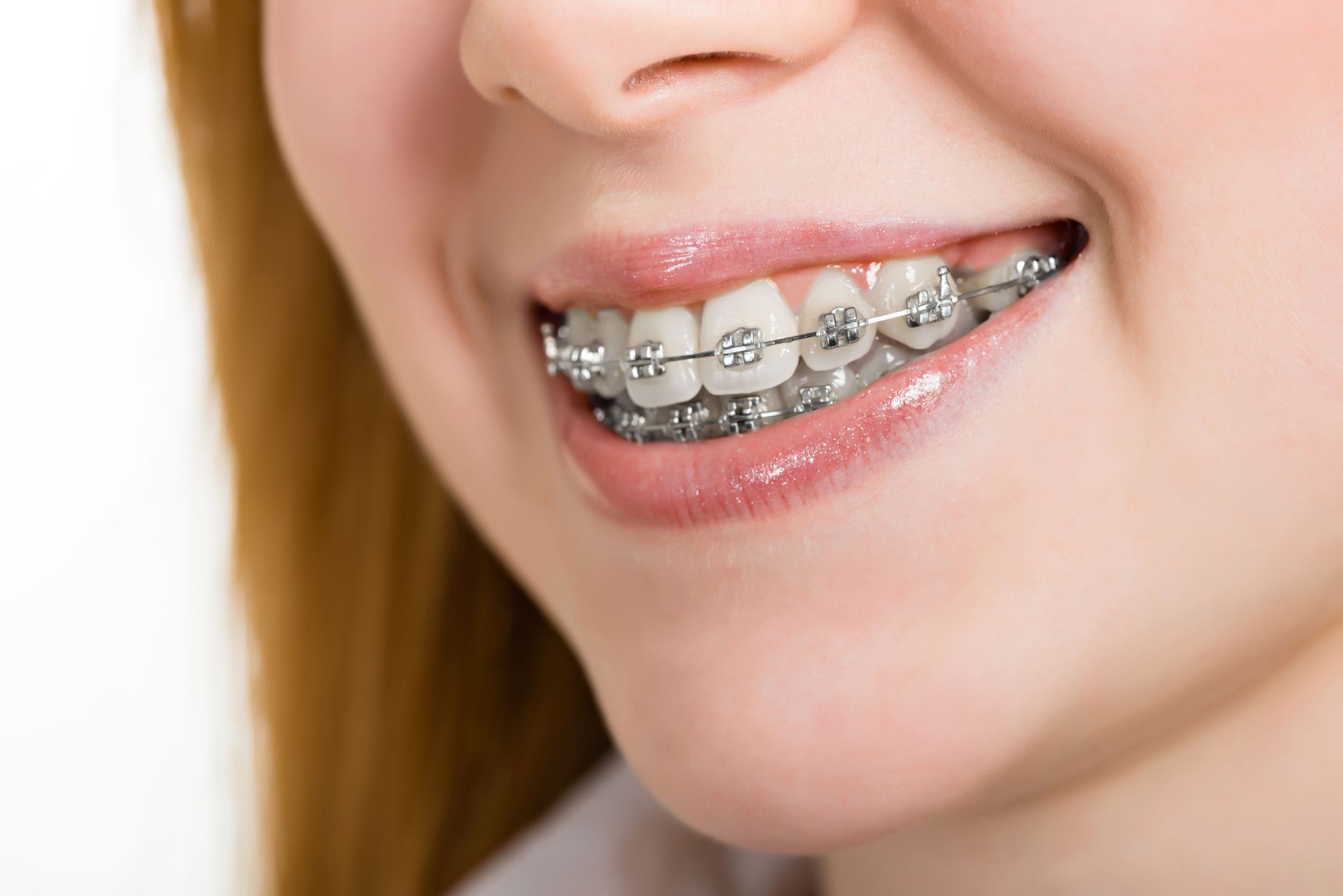 Questions to Ask Before Getting Dental Braces