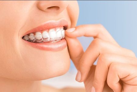 A close up of a woman 's mouth with braces on her teeth.