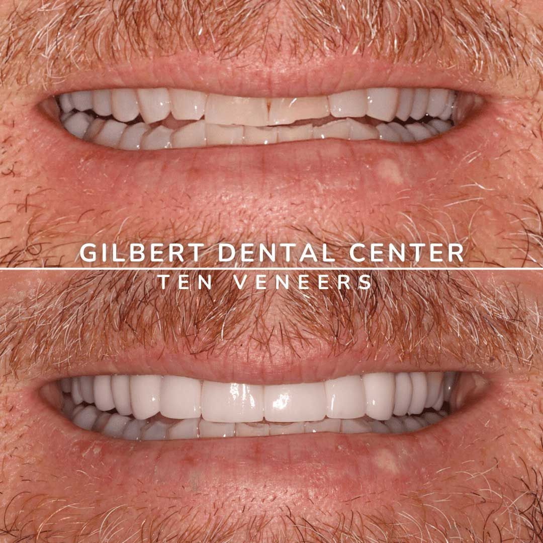Before-and-after of a man's smile. Top: Damaged teeth. Bottom: Ten veneers, white, perfectly aligned teeth.