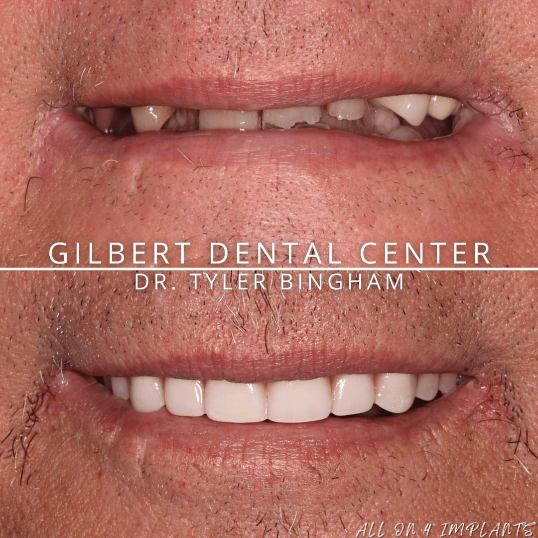 Before and after dental photo: top shows missing teeth, bottom shows complete smile with white teeth.