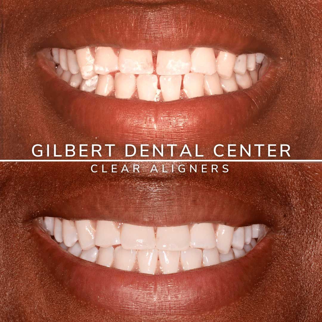 Top: misaligned teeth. Bottom: aligned teeth after clear aligners.