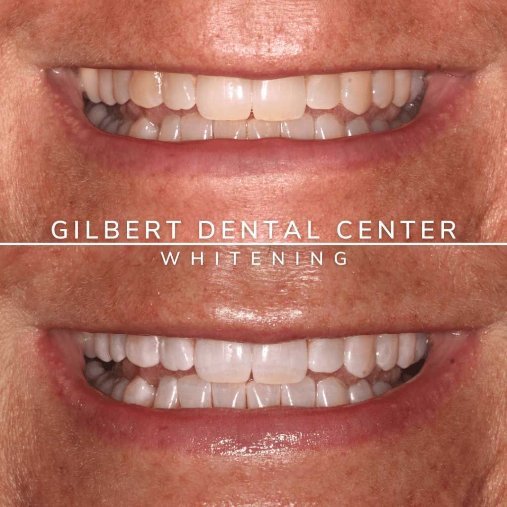 Side-by-side comparison of teeth, before and after whitening treatment at Gilbert Dental Center.