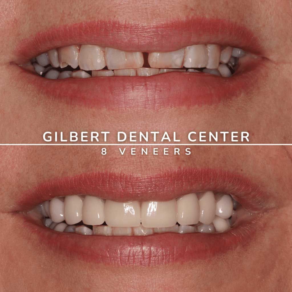 Before-and-after of dental veneers: upper teeth showing gaps and discoloration, then white, aligned teeth.