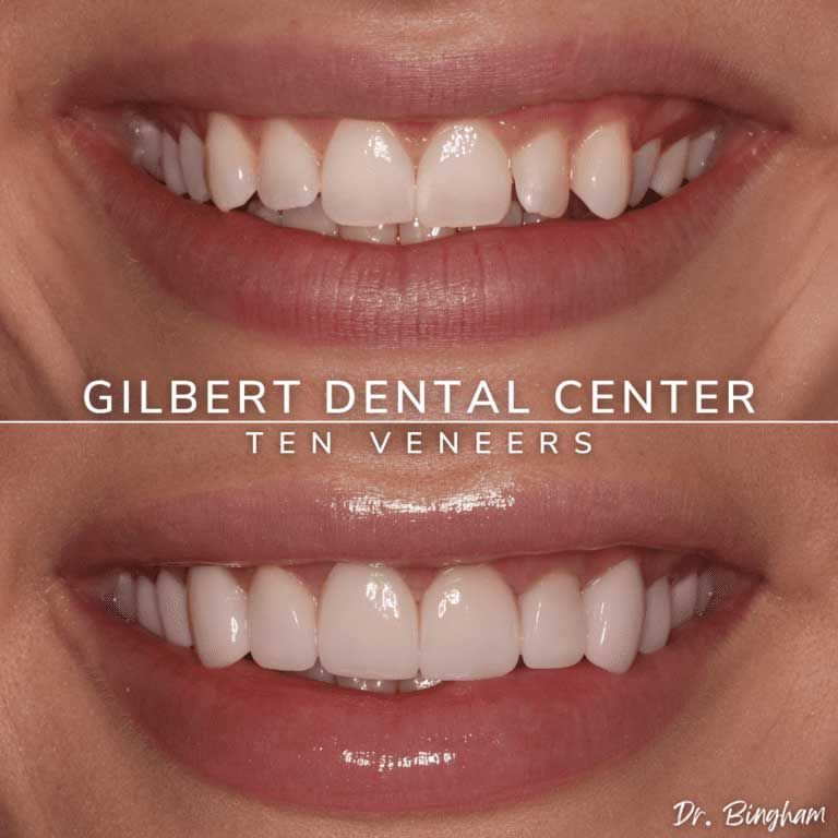 Before and after smile with 10 veneers; top: teeth slightly uneven; bottom: even, bright white teeth.