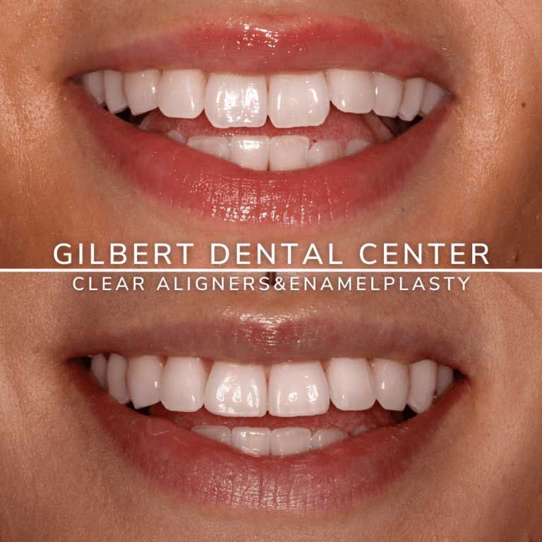 Before and after photos of a smile. Clear aligners and enamelplasty result in straighter, whiter teeth.