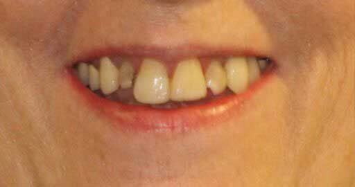 Close-up of a person's smile, showing upper teeth; some teeth are yellowed, and gaps are present.