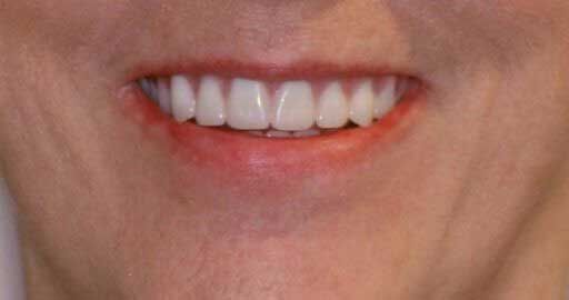 Close-up of a person's smiling mouth showing straight, white teeth and red lips.