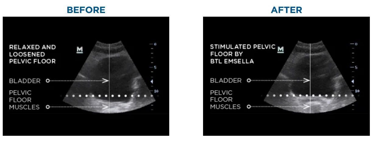 A before and after ultrasound of a woman 's abdomen.