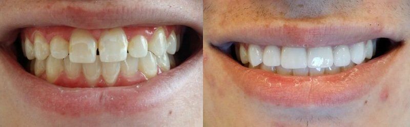 Smile makeover