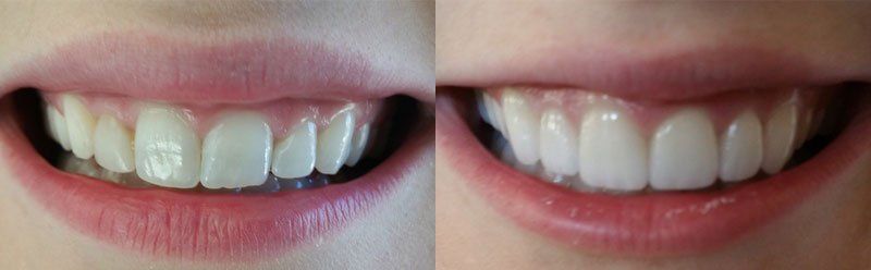 Smile makeover