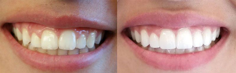 Smile makeover