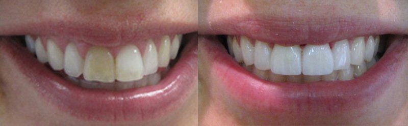 Smile makeover